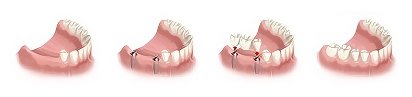 bridge sur implants dentaires au cabinet foulon ribemont