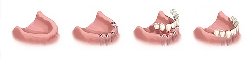 bridge circulaire sur implants dentaires au cabinet foulon ribemont