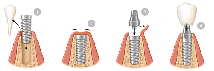 implants dentaires au cabinet foulon ribemont