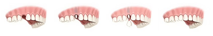 couronne sur implants dentaires au cabinet foulon ribemont